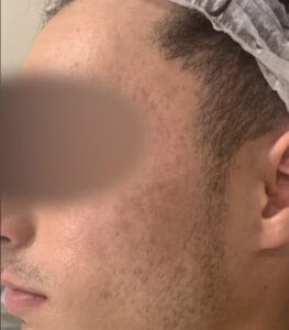 Peeling acne 1 apres floutee - Esthétical Paris