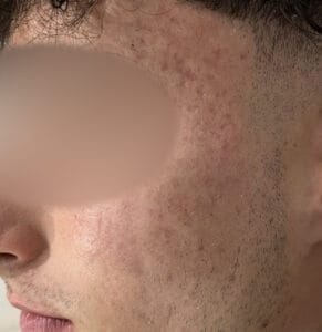 Peeling acne 1 avant floutee - Esthétical Paris